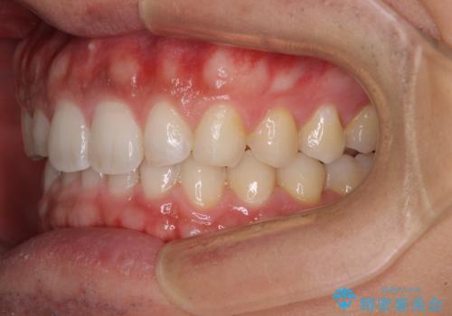 細かい隙間にものがはさまる インビザラインによる矯正治療の治療後