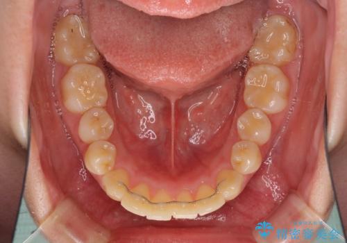 部分矯正で出っ歯になった 出っ歯改善の抜歯矯正の治療前