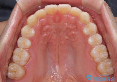 細かい隙間にものがはさまる インビザラインによる矯正治療の治療後