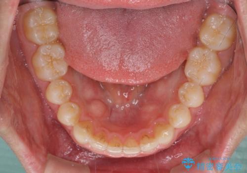 細かい隙間にものがはさまる インビザラインによる矯正治療の治療後