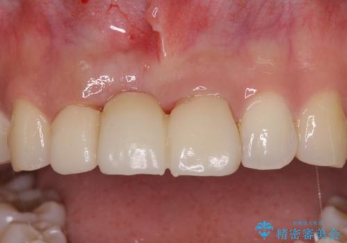 治療途中で放置した前歯 オールセラミックブリッジの治療中