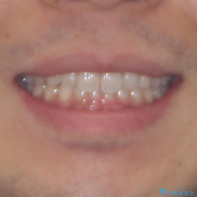 細かい隙間にものがはさまる インビザラインによる矯正治療の治療後(顔貌)