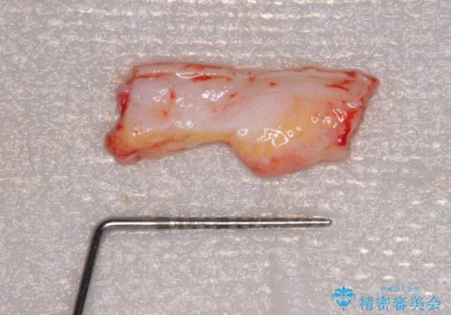 治療途中で放置した前歯 オールセラミックブリッジの治療前