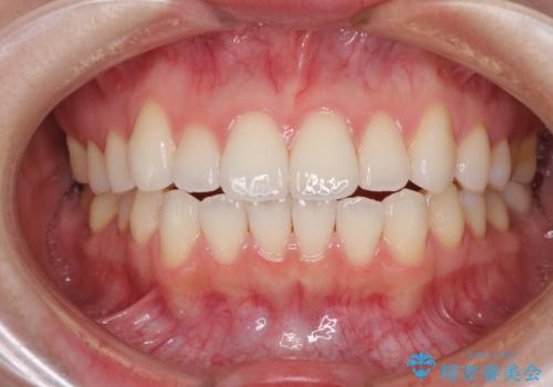 インビザライン・ライトにより後戻りの再矯正の治療前