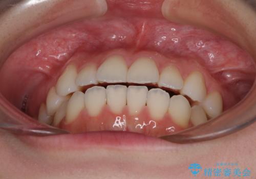 インビザライン・ライトにより後戻りの再矯正の治療前