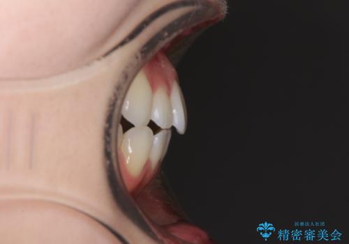 インビザライン・ライトにより後戻りの再矯正の治療前