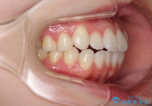 インビザライン・ライトにより後戻りの再矯正の治療前