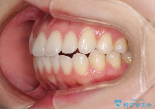 インビザライン・ライトにより後戻りの再矯正の治療前