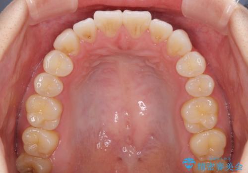 インビザライン・ライトにより後戻りの再矯正の治療前