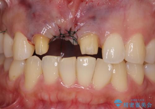 治療途中で放置した前歯 オールセラミックブリッジの治療中