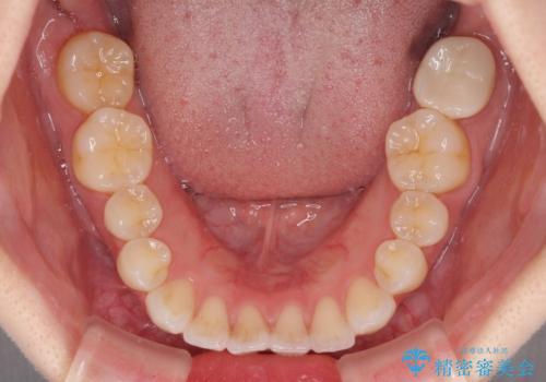 インビザライン・ライトにより後戻りの再矯正の治療前