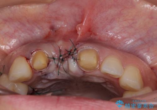 治療途中で放置した前歯 オールセラミックブリッジの治療中