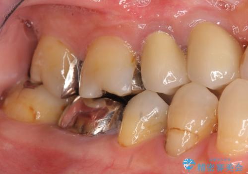 奥歯 抜歯してブリッジに 50代女性の治療前