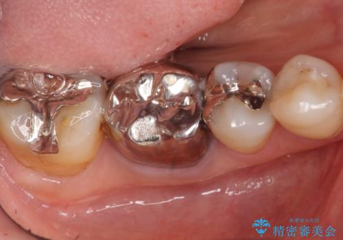 奥歯 抜歯してブリッジに 50代女性の治療前