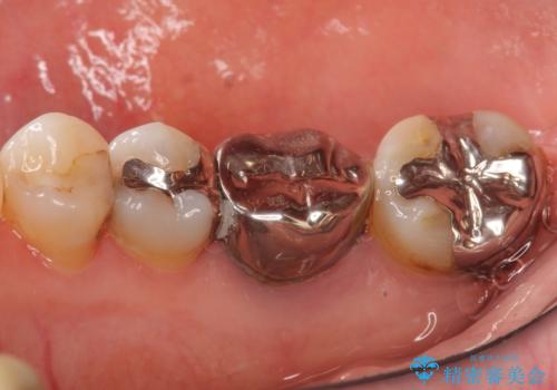 奥歯 抜歯してブリッジに 50代女性の症例 治療前