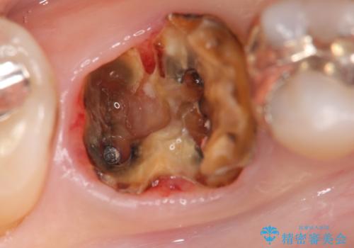 奥歯 抜歯してブリッジに 50代女性の治療中