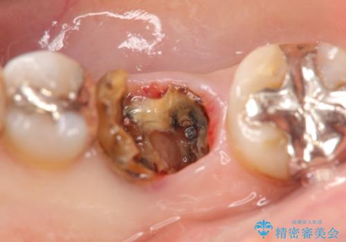 奥歯 抜歯してブリッジに 50代女性の治療前