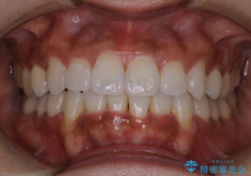 歯科衛生士による専門的なクリーニング PMTCの治療前