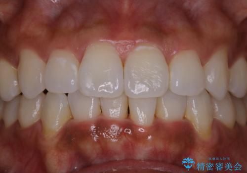 歯科衛生士による専門的なクリーニング PMTCの治療前