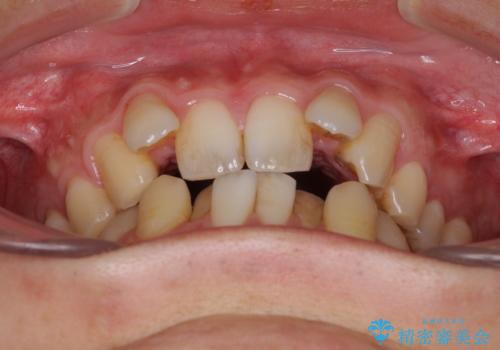 前歯のガタガタをきれいにしたい　ワイヤーによる抜歯矯正で整った歯並びへの治療前