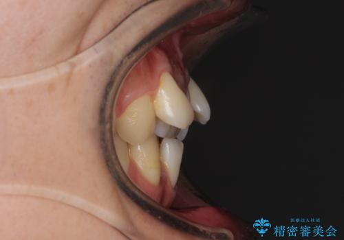 前歯のガタガタをきれいにしたい ワイヤーによる抜歯矯正で整った歯並びへの治療前