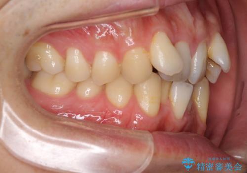 前歯のガタガタをきれいにしたい ワイヤーによる抜歯矯正で整った歯並びへの治療前