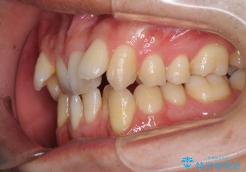 前歯のガタガタをきれいにしたい ワイヤーによる抜歯矯正で整った歯並びへの治療前