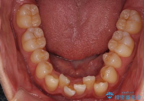 前歯のガタガタをきれいにしたい ワイヤーによる抜歯矯正で整った歯並びへの治療前