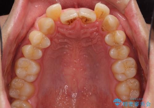 前歯のガタガタをきれいにしたい　ワイヤーによる抜歯矯正で整った歯並びへの治療前