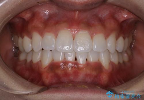 歯科衛生士による専門的なクリーニング PMTCの治療後