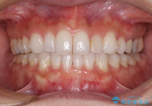 軽度の叢生をインビザライン・ライトで解消の治療中