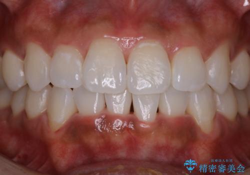 歯科衛生士による専門的なクリーニング PMTCの治療後