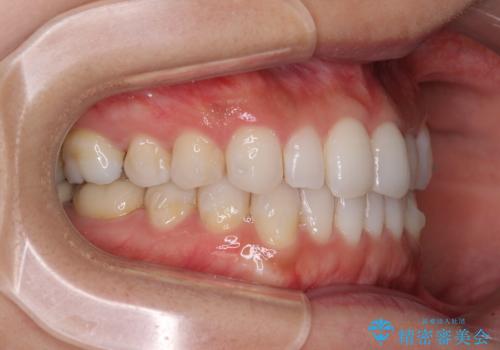 軽度の叢生をインビザライン・ライトで解消の治療中