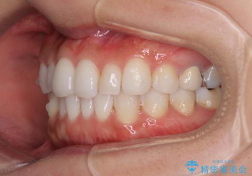 軽度の叢生をインビザライン・ライトで解消の治療中