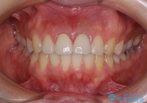 変色した前歯のクラウン オールセラミッククラウンにより審美歯科治療の治療後