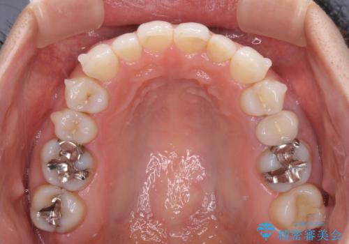 軽度の叢生をインビザライン・ライトで解消の治療中