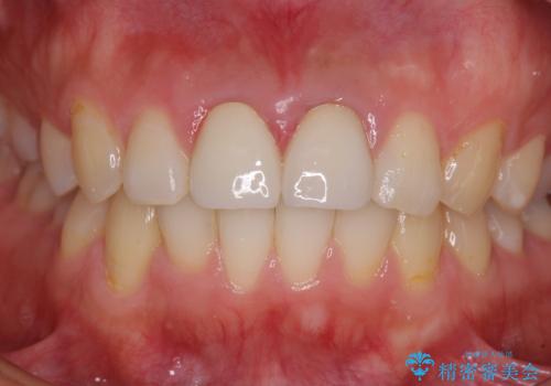 変色した前歯のクラウン　オールセラミッククラウンにより審美歯科治療の治療後