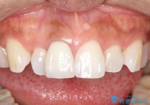 前歯の色が気になる、オールセラミッククラウンによる治療の治療後