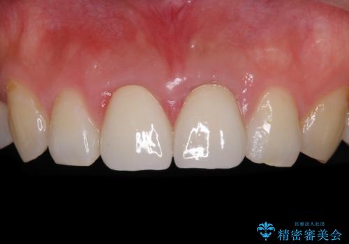 変色した前歯のクラウン オールセラミッククラウンにより審美歯科治療の治療後