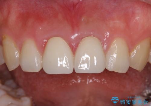 変色した前歯のクラウン オールセラミッククラウンにより審美歯科治療の治療後