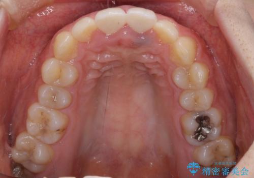 変色した前歯のクラウン オールセラミッククラウンにより審美歯科治療の治療後