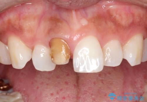 前歯の色が気になる、オールセラミッククラウンによる治療の治療中