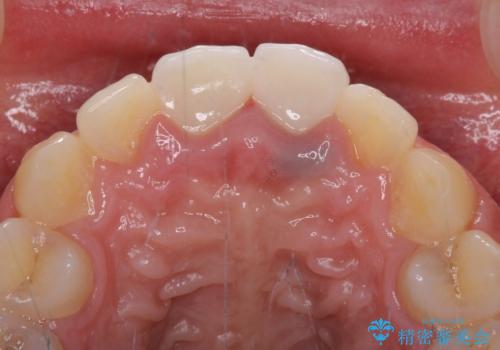 変色した前歯のクラウン オールセラミッククラウンにより審美歯科治療の治療後