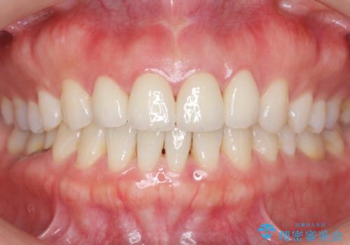 美容外科による不自然なかぶせもので、前歯がコンプレックスに。自然なセラミックにやりかえ 30代女性の治療後