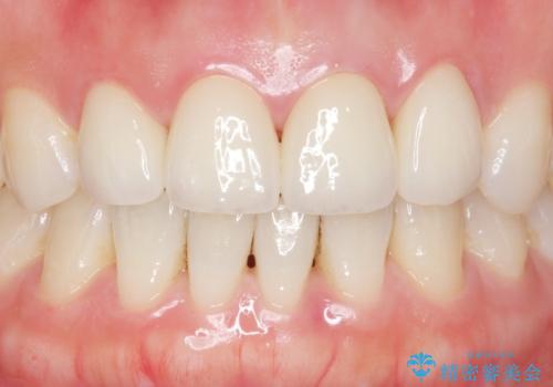 美容外科による不自然なかぶせもので、前歯がコンプレックスに。自然なセラミックにやりかえ 30代女性の治療後