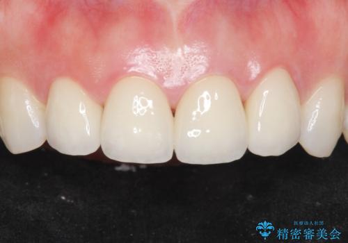美容外科による不自然なかぶせもので、前歯がコンプレックスに。自然なセラミックにやりかえ 30代女性の症例 治療後