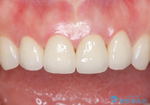 美容外科による不自然なかぶせもので、前歯がコンプレックスに。自然なセラミックにやりかえ 30代女性の治療後