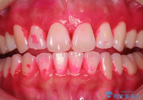 染め出しをしての歯磨き指導とPMTCの治療前