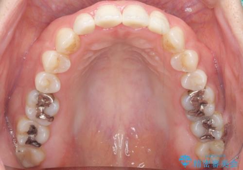 美容外科による不自然なかぶせもので、前歯がコンプレックスに。自然なセラミックにやりかえ 30代女性の治療後