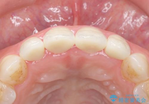 美容外科による不自然なかぶせもので、前歯がコンプレックスに。自然なセラミックにやりかえ 30代女性の治療後